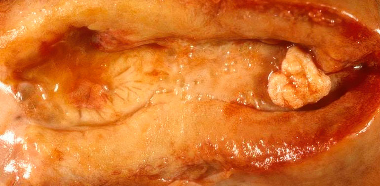 Endometrial Polyp
