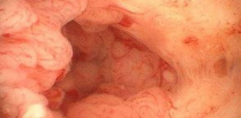 Endometrial Hiperplaziya