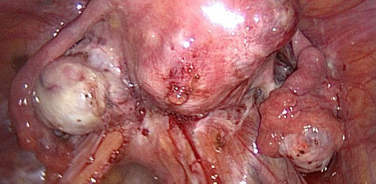 Adenomyosis