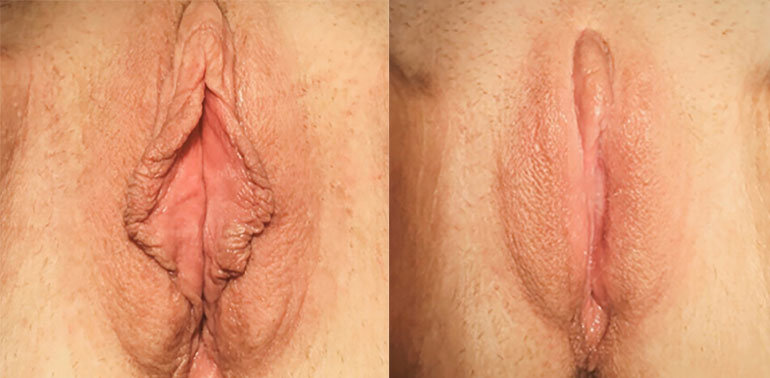 Genital estetik əməliyyatlar – Labioplastika