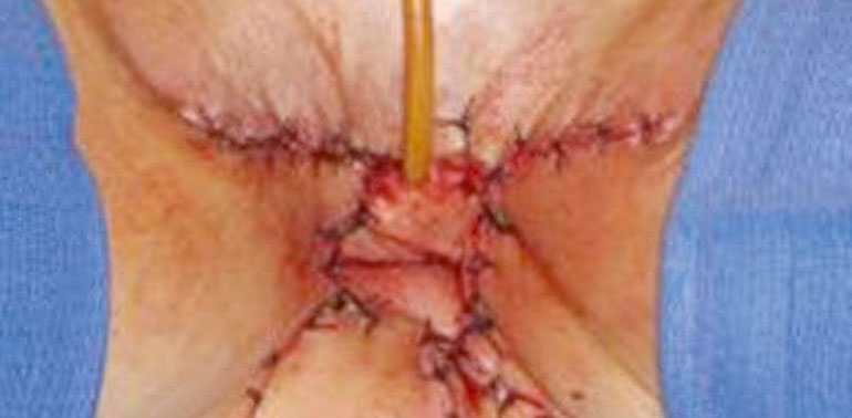 Vulva xərçəngi əməliyyatları (vulvektomiya)