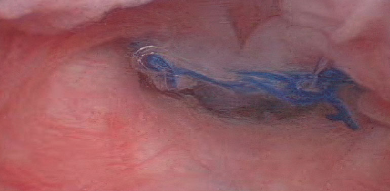 Sidik qaçırma və genital orqan sallanması ilə bağlı ginekoloji əməliyyatlar