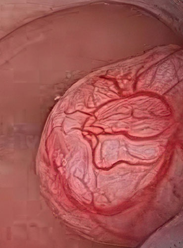 Endometrial hiperplaziya əməliyyatları