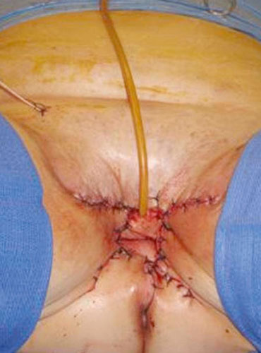 Vulva xərçəngi əməliyyatları (vulvektomiya)