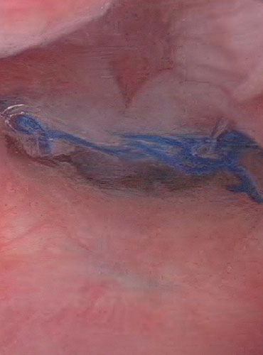 Sidik qaçırma və genital orqan sallanması ilə bağlı ginekoloji əməliyyatlar